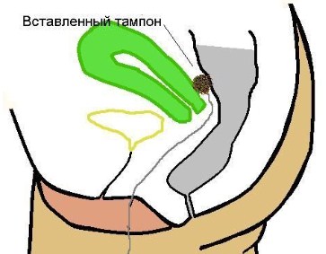 Правильное положение тампона clean point или beautiful life